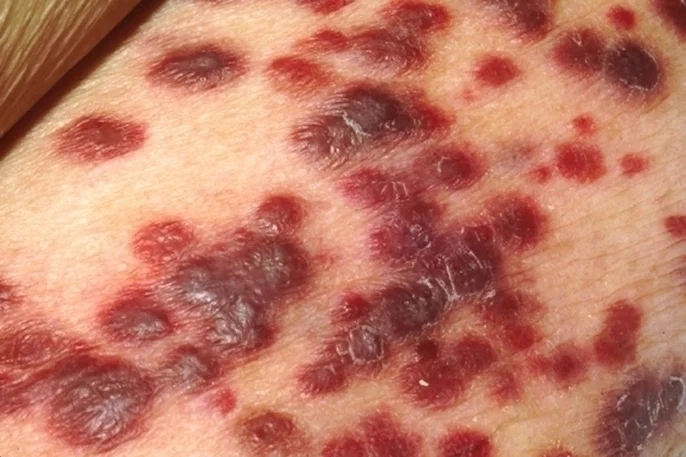 Melanoma e Câncer de Pele