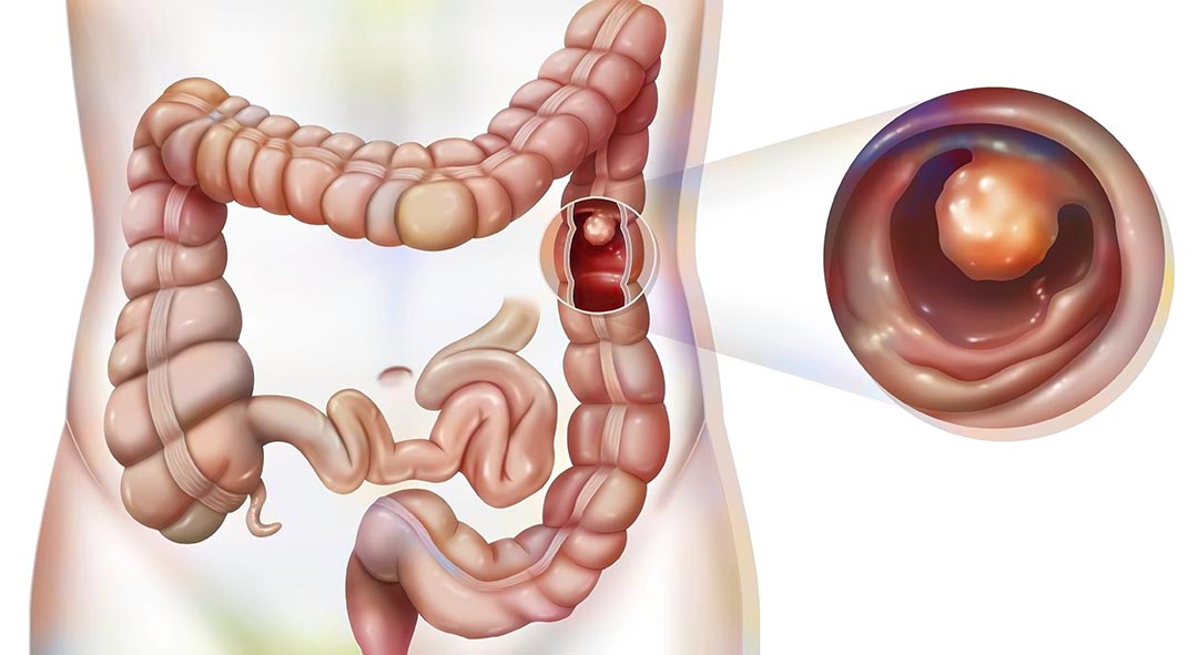 Tumores Gastrointestinais